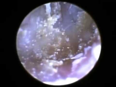 Mites in the External Auditory Canal