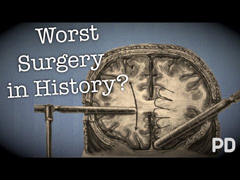 The Dark side of Science: The Lobotomy, the worst surgery in history? (Documentary)
