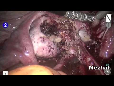 Robotic Assisted Laparoscopic Excision of Endometrioma