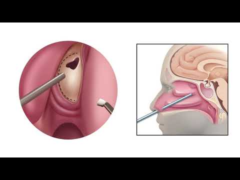 Endoscopic Endonasal Approach for Pituitary Tumor Removal