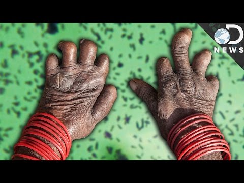 What Happens When You Get Leprosy?