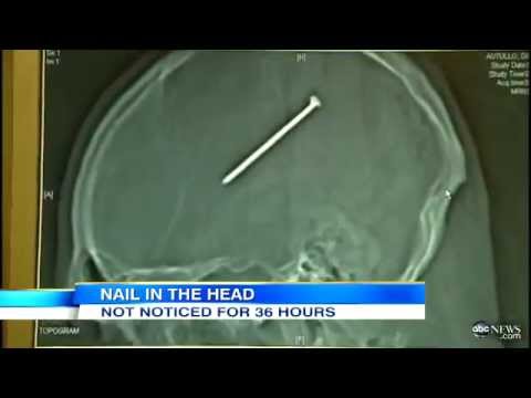 Man shot nail into brain and didn&#039;t know it