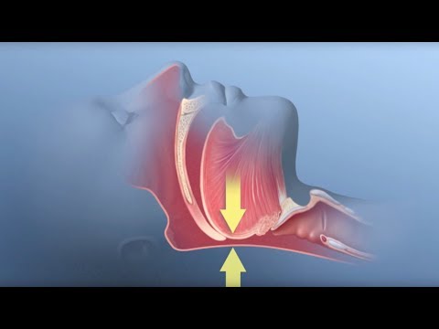 Obstructive Sleep Apnea - Mayo Clinic