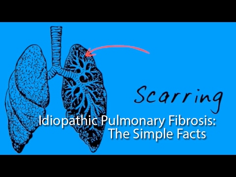 Idiopathic Pulmonary Fibrosis: The Simple Facts