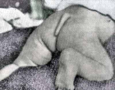 Top 10 Bizarre Birth Defects - 16