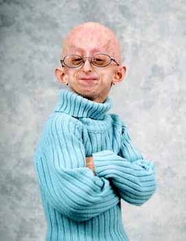 Progeria8