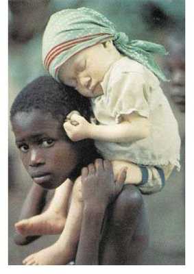 Albino-Human-African-B
