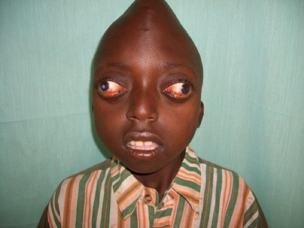 10 People With Shocking and Extreme Deformities - 53