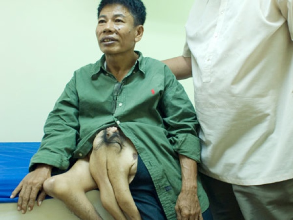 10 People With Shocking and Extreme Deformities - 59