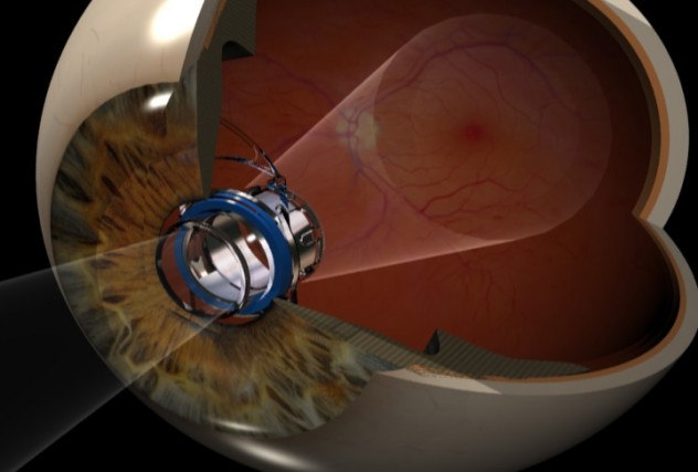 eye-implant-diagram-lge