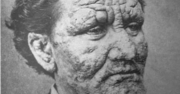 10 Ways Leprosy Was Nothing Like You Thought Listverse