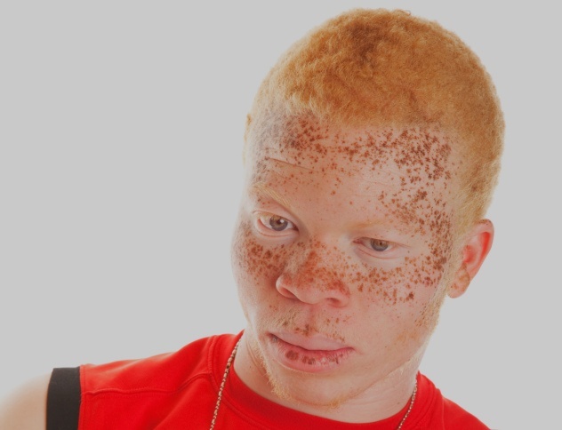 Albino 3