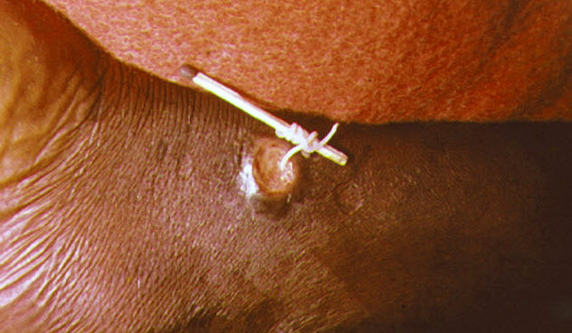 6-guinea-worm-disease