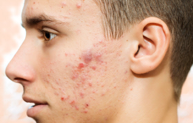 6a-acne-use-this_000022138719_Small