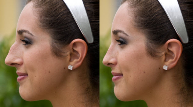 7-before-after-nose-job_000007132977_Small