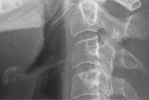 Hyoid Bone X-ray