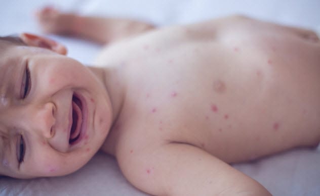 8a-measles_85432851_small