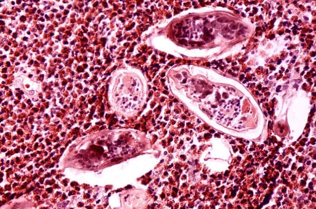 1-schistosomiasis-parasite-eggs-in-bladder