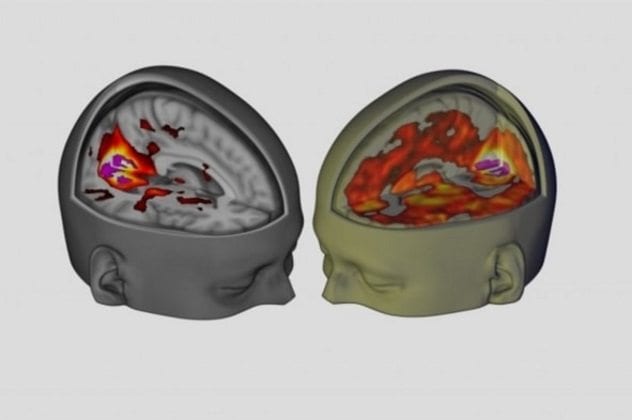 Normal vs LSD Brain