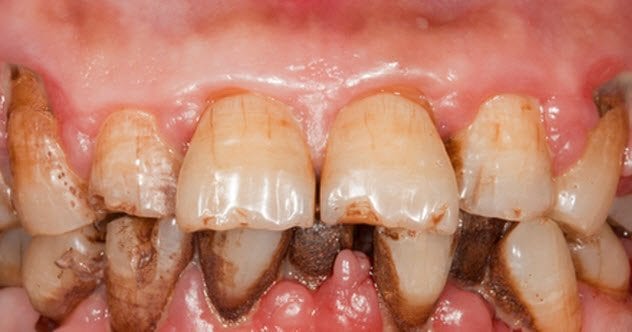 8-gum-disease-177106913