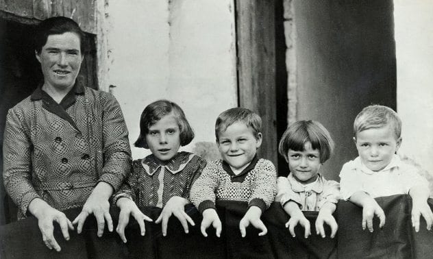 Ectrodactyly-Family-1930