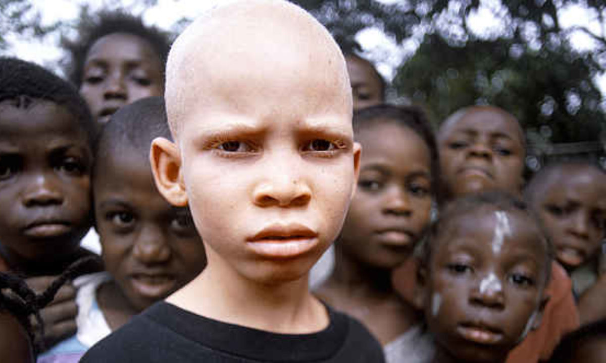 albino african american baby