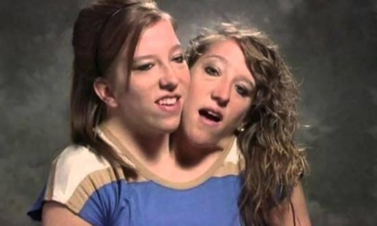 Amazing story of conjoined twins Abigail and Brittany Hensel