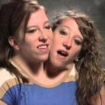 10 Interesting Stories Of Conjoined Twins