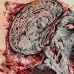 10 Frightening Facts About The Mysterious Deadly Prion Diseases
