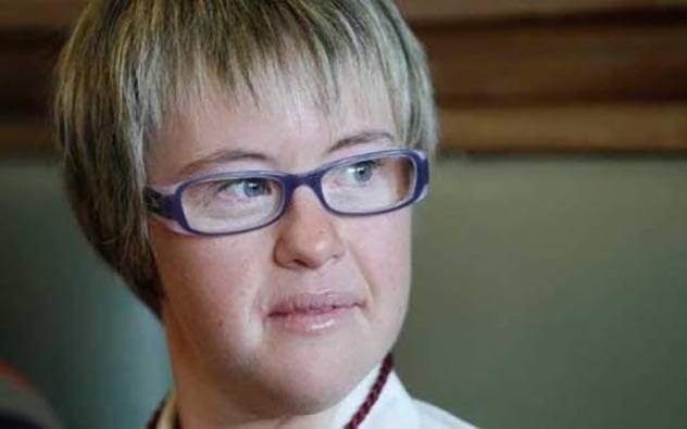 Physical Appearance Mosaic Down Syndrome Celebrities Beautifulbillo