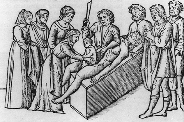 Top 10 Bloody Histories Behind Common Surgeries - 52